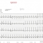 ecg1a